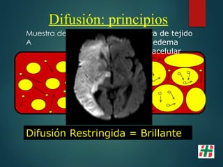 Muestra de tejido
A
Muestra de tejido
B: edema
intracelular
Difusión Restringida = Brillante
Difusión: principios
 