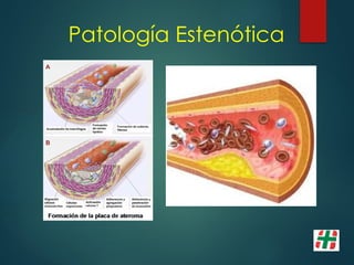 Patología Estenótica
 