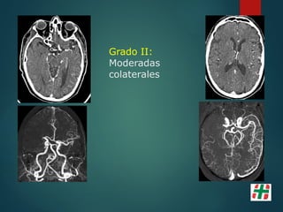Grado II:
Moderadas
colaterales
 