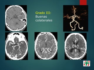 Grado III:
Buenas
colaterales
 