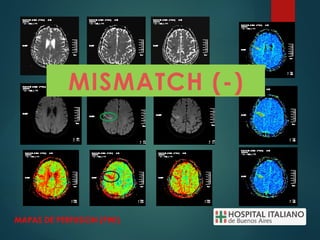 MAPAS DE PERFUSION (PWI)
MISMATCH (-)
 