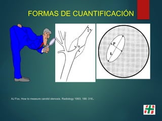 FORMAS DE CUANTIFICACIÓN
AJ Fox. How to measure carotid stenosis. Radiology 1993; 186: 316.
 