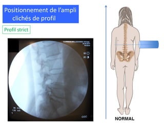 Profil strict
Positionnement de l’ampli
clichés de profil
 