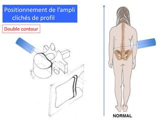 Double contour
Positionnement de l’ampli
clichés de profil
 