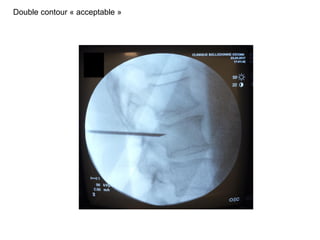 Double contour « acceptable »
 