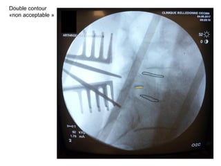 Double contour
«non acceptable »
 