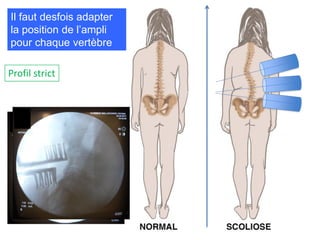 Il faut desfois adapter
la position de l’ampli
pour chaque vertèbre
Profil strict
 