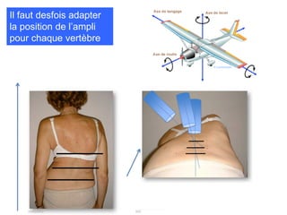 Il faut desfois adapter
la position de l’ampli
pour chaque vertèbre
 