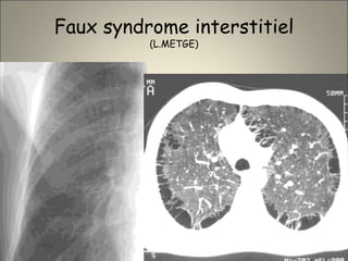 Faux syndrome interstitiel
(L.METGE)
 