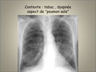 Contexte : tabac , dyspnée
aspect de ‟poumon sale”
 