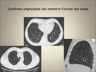Syndrome emphysème des sommets-fibrose des bases
 