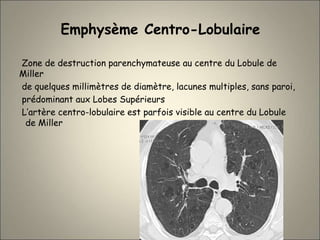Emphysème Centro-Lobulaire
Zone de destruction parenchymateuse au centre du Lobule de
Miller
de quelques millimètres de diamètre, lacunes multiples, sans paroi,
prédominant aux Lobes Supérieurs
L’artère centro-lobulaire est parfois visible au centre du Lobule
de Miller
 