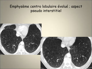 Emphysème centro lobulaire évolué ; aspect
pseudo interstitiel
 
