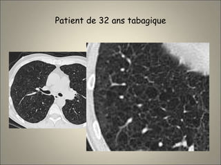 Patient de 32 ans tabagique
 
