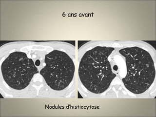 6 ans avant
Nodules d’histiocytose
 