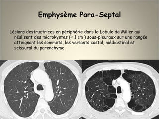 Emphysème Para-Septal
Lésions destructrices en périphérie dans le Lobule de Miller qui
réalisent des microkystes (˂ 1 cm ) sous-pleuraux sur une rangée
atteignant les sommets, les versants costal, médiastinal et
scissural du parenchyme
 