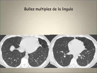 Bulles multiples de la lingula
 