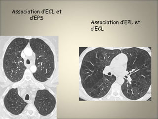 Association d’ECL et
d’EPS
Association d’EPL et
d’ECL
 