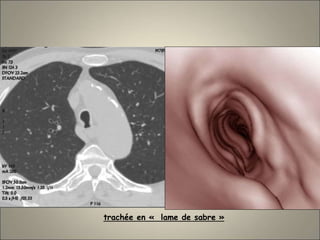 trachée en « lame de sabre »
 