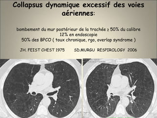Collapsus dynamique excessif des voies
aériennes:
bombement du mur postérieur de la trachée ≥ 50% du calibre
12% en endoscopie
50% des BPCO ( toux chronique, rgo, overlap syndrome )
JH. FEIST CHEST 1975 SD.MURGU RESPIROLOGY 2006
 