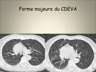 Forme majeure du CDEVA
 