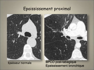 Epaississement proximal
Epaisseur normale BPCO post-tabagique
Epaississement bronchique
 