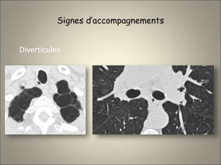 Signes d’accompagnements
Diverticules
 