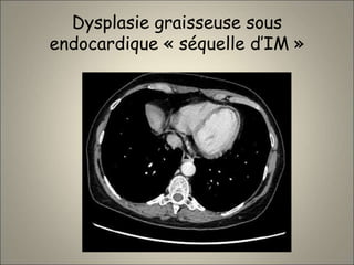 Dysplasie graisseuse sous
endocardique « séquelle d’IM »
 