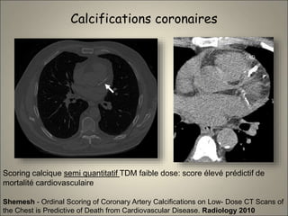 Calcifications coronaires
Shemesh - Ordinal Scoring of Coronary Artery Calcifications on Low- Dose CT Scans of
the Chest is Predictive of Death from Cardiovascular Disease. Radiology 2010
Scoring calcique semi quantitatif TDM faible dose: score élevé prédictif de
mortalité cardiovasculaire
 