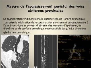 Mesure de l’épaississement pariétal des voies
aériennes proximales
La segmentation tridimensionnelle automatisée de l'arbre bronchique
autorise la réalisation de reconstruction strictement perpendiculaire à
l'axe bronchique et permet d'obtenir des mesures d'épaisseur, de
diamètre ou de surface bronchique reproductible jusqu'à La cinquième
génération bronchique .
 
