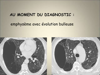 AU MOMENT DU DIAGNOSTIC :
emphysème avec évolution bulleuse
 