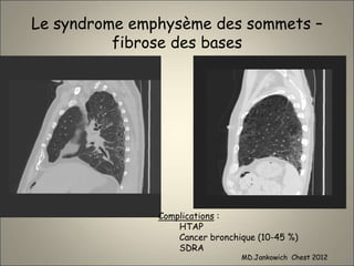 Le syndrome emphysème des sommets –
fibrose des bases
Complications :
HTAP
Cancer bronchique (10-45 %)
SDRA
MD.Jankowich Chest 2012
 