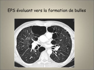 EPS évoluant vers la formation de bulles
 