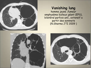 Vanishing lung
homme jeune ,fumeur
emphysème bulleux géant (EPS),
bilatéral parfois unil., extensif a
partir des sommets
(N.Sharma JTI 2009 )
 