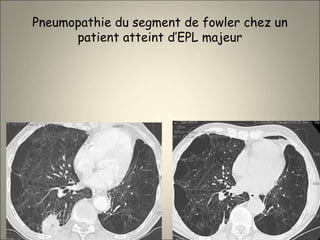 Pneumopathie du segment de fowler chez un
patient atteint d’EPL majeur
 