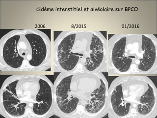Œdème interstitiel et alvéolaire sur BPCO
2006 8/2015 01/2016
 
