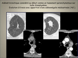 AdénoK bronchique considéré au début comme un tassement parenchymateux sur
bulle d’emphysème.
Evolution à 8 mois avec apparition d’une adénomégalie médiastinale ( N2 ).
 
