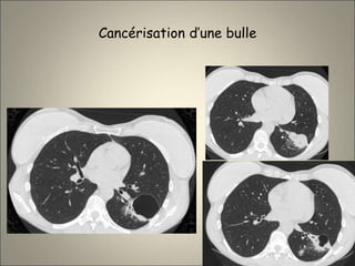 Cancérisation d’une bulle
 
