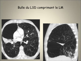 Bulle du LSD comprimant le LM
 