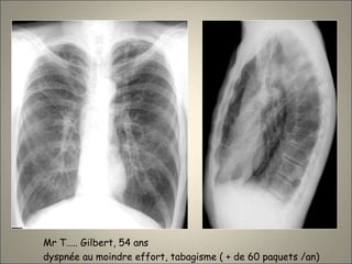 Mr T….. Gilbert, 54 ans
dyspnée au moindre effort, tabagisme ( + de 60 paquets /an)
 
