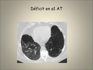 Déficit en α1 AT
 