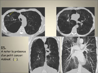EPL.
A noter la présence
d’un petit cancer:
AdénoK ( ).
 