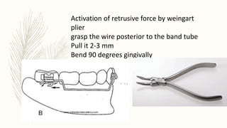 Activation of retrusive force by weingart
plier
grasp the wire posterior to the band tube
Pull it 2-3 mm
Bend 90 degrees gingivally
 