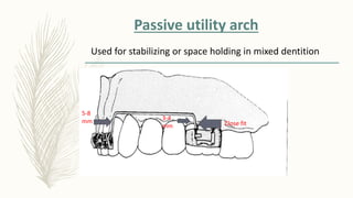 Passive utility arch
Close fit
3-4
mm
5-8
mm
Used for stabilizing or space holding in mixed dentition
 