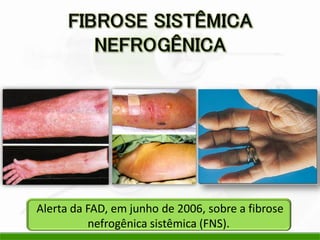 Alerta da FAD, em junho de 2006, sobre a fibrose
nefrogênica sistêmica (FNS).
 