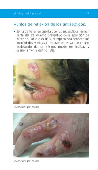 ¿dónde? ¿cuándo? ¿por qué? 21 
Puntos de reflexión de los antisépticos: 
• Se ha de tener en cuenta que los antisépticos forman 
par te del tratamiento preventivo de la aparición de 
infección. Por ello es de vital impor tancia conocer sus 
propiedades, ventajas e inconvenientes, ya que un uso 
inadecuado de los mismos puede ser ineficaz y 
ocasionalmente dañino. [38]. 
Quemadura por fricción. 
Quemadura por fricción. 
 