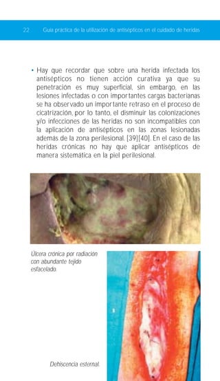 22 Guía práctica de la utilización de antisépticos en el cuidado de heridas 
• Hay que recordar que sobre una herida infectada los 
antisépticos no tienen acción curativa ya que su 
penetración es muy superficial, sin embargo, en las 
lesiones infectadas o con importantes cargas bacterianas 
se ha observado un importante retraso en el proceso de 
cicatrización, por lo tanto, el disminuir las colonizaciones 
y/o infecciones de las heridas no son incompatibles con 
la aplicación de antisépticos en las zonas lesionadas 
además de la zona perilesional. [39][40]. En el caso de las 
heridas crónicas no hay que aplicar antisépticos de 
manera sistemática en la piel perilesional. 
Úlcera crónica por radiación 
con abundante tejido 
esfacelado. 
Dehiscencia esternal. 
 