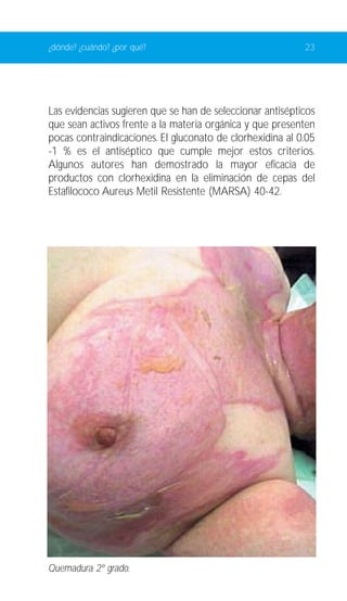 ¿dónde? ¿cuándo? ¿por qué? 23 
Las evidencias sugieren que se han de seleccionar antisépticos 
que sean activos frente a la materia orgánica y que presenten 
pocas contraindicaciones. El gluconato de clorhexidina al 0.05 
-1 % es el antiséptico que cumple mejor estos criterios. 
Algunos autores han demostrado la mayor eficacia de 
productos con clorhexidina en la eliminación de cepas del 
Estafilococo Aureus Metil Resistente (MARSA) 40-42. 
Quemadura 2º grado. 
 