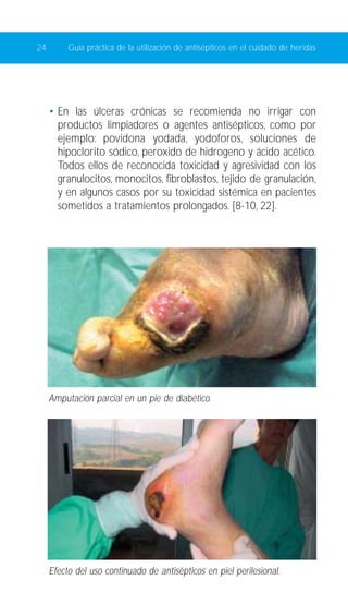 24 Guía práctica de la utilización de antisépticos en el cuidado de heridas 
• En las úlceras crónicas se recomienda no irrigar con 
productos limpiadores o agentes antisépticos, como por 
ejemplo: povidona yodada, yodoforos, soluciones de 
hipoclorito sódico, peroxido de hidrogeno y ácido acético. 
Todos ellos de reconocida toxicidad y agresividad con los 
granulocitos, monocitos, fibroblastos, tejido de granulación, 
y en algunos casos por su toxicidad sistémica en pacientes 
sometidos a tratamientos prolongados. [8-10, 22]. 
Amputación parcial en un pie de diabético. 
Efecto del uso continuado de antisépticos en piel perilesional. 
 