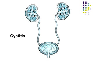 Cystitis
 